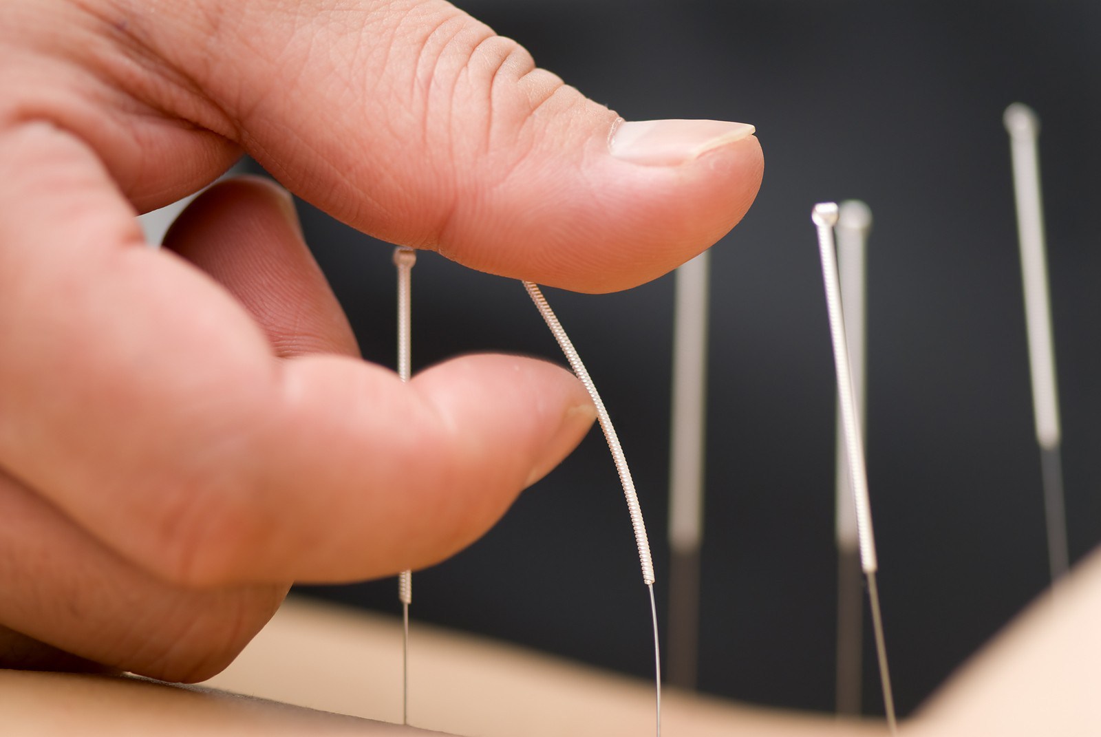 The most acupuncture treatments Meditate for good health