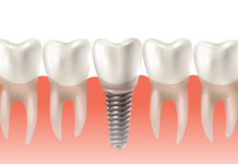 Dental Implant Is the most Appropriate Choice to Replace Tooth Loss