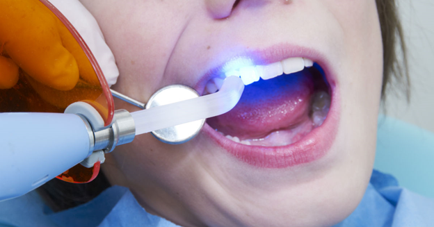Dental Sealant Therapy
