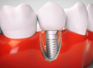 Do Dental Implants Cause Complications for People?