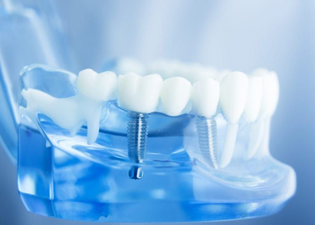 Dental Implants: The Best Option to Solve Tooth Loss